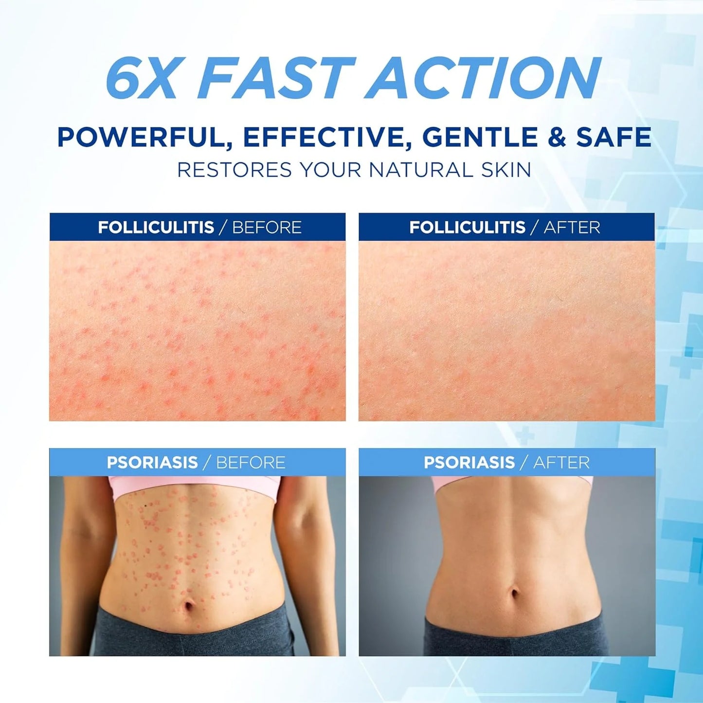 Folliculitis Treatment Cream