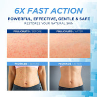 Folliculitis Treatment Cream