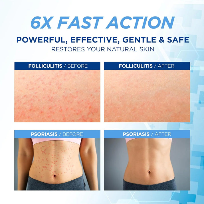 Folliculitis Treatment Cream